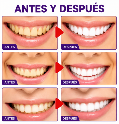 2 Smilekit BLANQUEADOR DENTAL