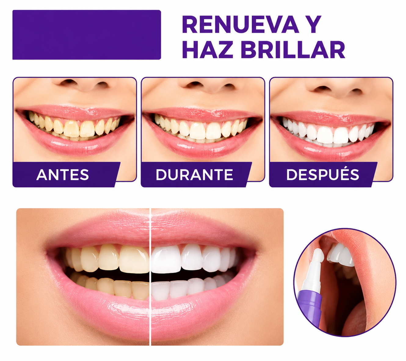 2 Smilekit BLANQUEADOR DENTAL