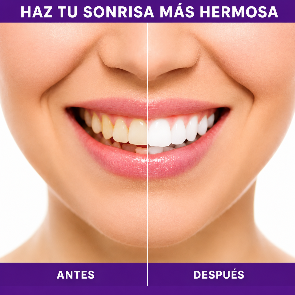 2 Smilekit BLANQUEADOR DENTAL